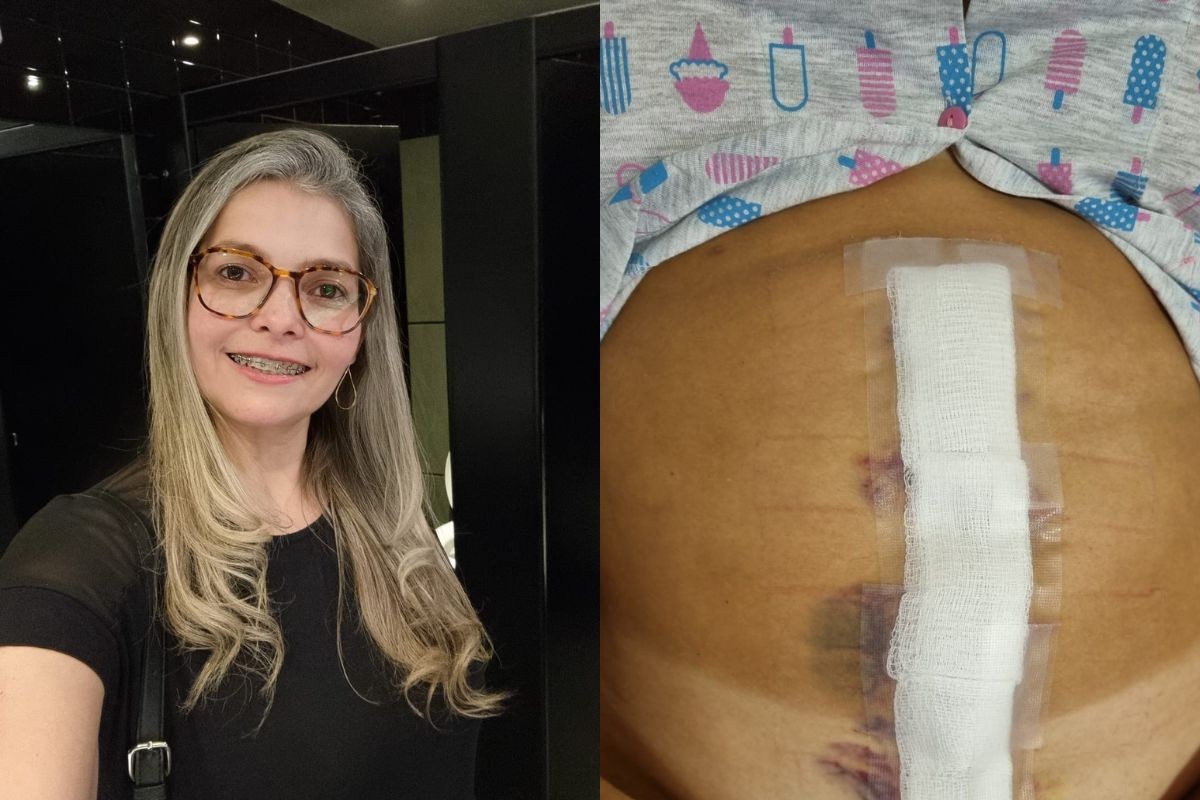 Sem sintomas, brasileira que vive na Irlanda descobre tumor raro de 20 cm em exames de rotina e busca ajuda: ‘tinha vida normal’ | Mais Saúde